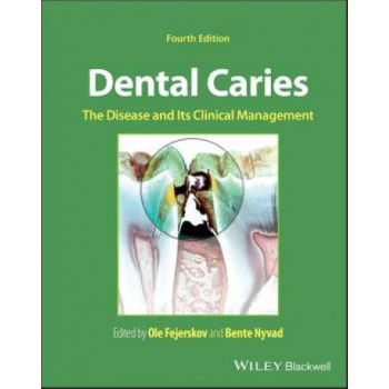 Dental Caries: The Disease and its Clinical Management